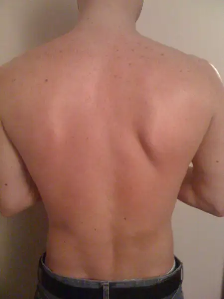 After: Swipe To View More Images